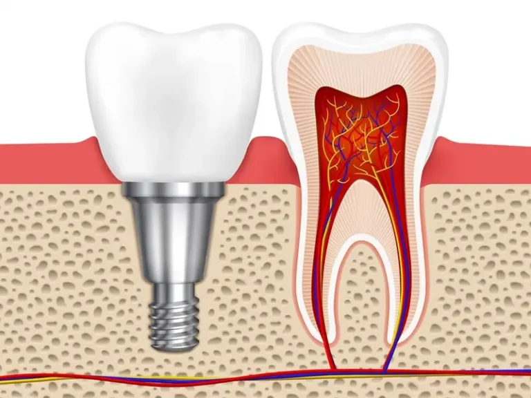 Understanding Root Canal Treatment: Why You Might Need One